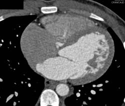 RCA Arises Off the Left Cusp and Tracks Anteriorly Between the Ascending Aorta and Main Pulmonary Trunk- Multiple Presentations - CTisus CT Scan