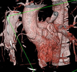 Normal Right Circulation - CTisus CT Scan