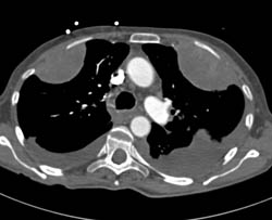 Metastatic Sarcoma Involves Left Pulmonary Artery and Left Ventricle - CTisus CT Scan