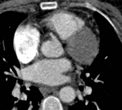 Venous Bypass - CTisus CT Scan