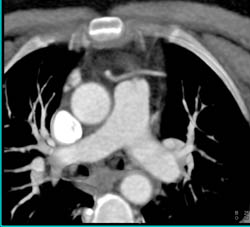 RCA Off Left Cusp But Graft Off Right Cusp Tracks to Normal LAD - CTisus CT Scan