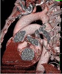 Coa With Bicuspid Valve - CTisus CT Scan