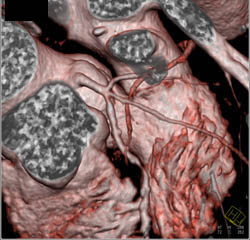 Left Main Coronary Artery With Trifurcation. Multiple Calcified Plaques in LAD - CTisus CT Scan