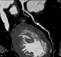 LAD Plaques With Less Then 50% Stenosis - CTisus CT Scan