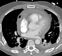 Hemopericardium With Air in Pericardium - CTisus CT Scan