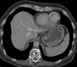 Pericardial Calcification With Ventricular Infarct - CTisus CT Scan