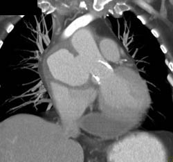 Pseudoaneurysm Off Aortic Root Repair - CTisus CT Scan