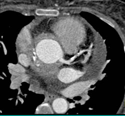 Inflammatory Aortitis in Root of Ascending Aorta - CTisus CT Scan