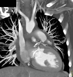 Aortic Valve Replacement (AVR) and MVR With Aortic Root Repair - CTisus CT Scan