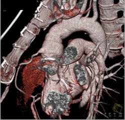 RCA Re-implanted on Ascending Aorta - CTisus CT Scan