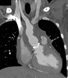 Aortic Valve Replacement (AVR) With Aortic Root Repair - CTisus CT Scan