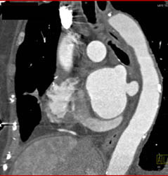 Thrombus in Right Atrium Near Catheter in Right Atrium - CTisus CT Scan