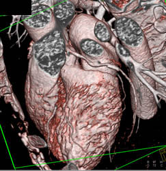 Normal Circumflex Coronary Artery - CTisus CT Scan