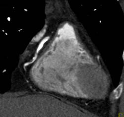 RCA Plaque With Stenosis - CTisus CT Scan