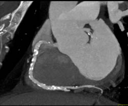 Multiple RCA Plaques - CTisus CT Scan