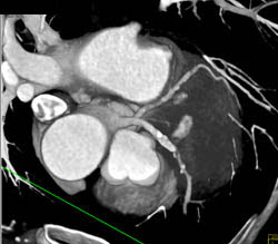 LAD and Circumflex Plaques - CTisus CT Scan