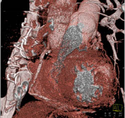 Aortic Root Pseudoaneurysm Extends Into the Chest Wall - CTisus CT Scan