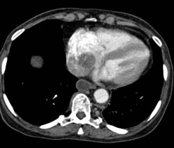 Thrombus in the Right Atrium With Abdominal Nodes - CTisus CT Scan