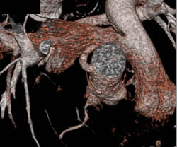 Re-implanted Left Coronary Artery - CTisus CT Scan