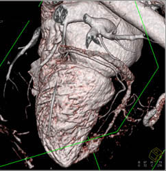 Circumflex Coronary Artery and Adjacent Veins - CTisus CT Scan