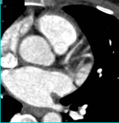 LAD Plaque With Stenosis - CTisus CT Scan