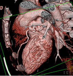 Normal LAD and Ramus Intermedius - CTisus CT Scan