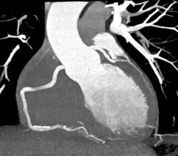 Calcified Plaque in RCA Without Stenosis - CTisus CT Scan