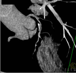 Plaque LAD Without Stenosis - CTisus CT Scan