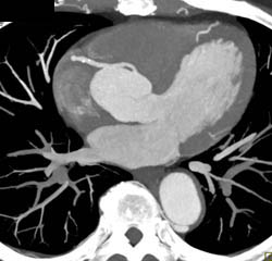 Normal RCA on MIP Images - CTisus CT Scan