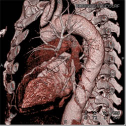 LAD in Various Projections - CTisus CT Scan