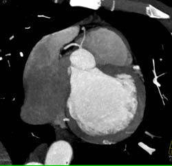 Av Nodal Branch Off RCA - CTisus CT Scan