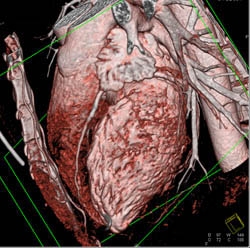 Relationship of Left Ventricle to LAD and Circumflex Coronary Artery - CTisus CT Scan