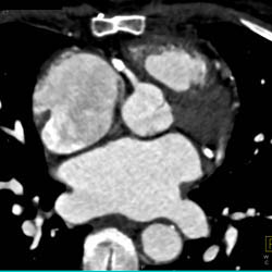 RCA Stents - CTisus CT Scan