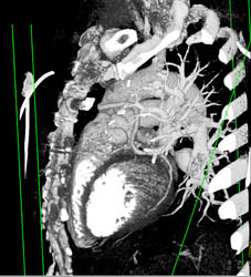 Patent Venous Bypass - CTisus CT Scan