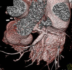 Coronary Artery Aneurysm- LAD - CTisus CT Scan