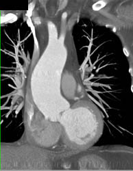 Ectopic Beat Artifact Fixed on Subsequent Images - CTisus CT Scan