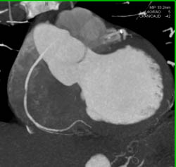 LAD Plaque and Normal RCA - CTisus CT Scan