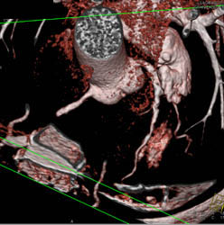 RCA and LAD Plaque - CTisus CT Scan