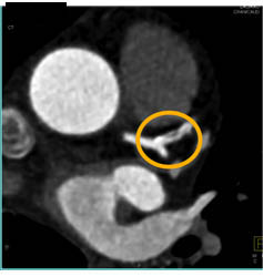 LAD Stenosis With Non-calcified Plaque. Patient Has Stent in Circumflex as Well - CTisus CT Scan