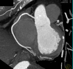 LAD Stenosis Is Less Than 50% - CTisus CT Scan