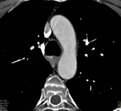 Routine Chest CT in Flash Mode Gives Diagnostic Quality Coronary Artery Evaluation. LAD Shows Extensive Plaque - CTisus CT Scan