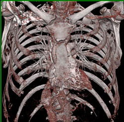 Dilated Ascending Aorta With Normal Branch Vessels - CTisus CT Scan