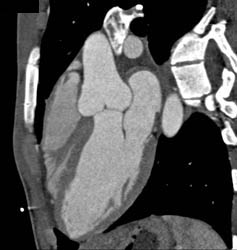 Dilated Sinus of Valsalva Due to Marfan Syndrome - CTisus CT Scan