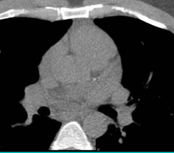 LAD Plaque in Multiple Images and Projections - CTisus CT Scan