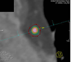 Vessel Analysis to Determine Plaque Composition - CTisus CT Scan