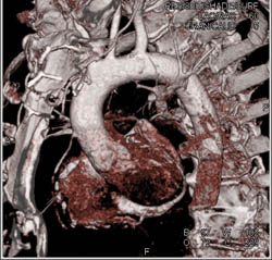 Reimplanted RCA Without Complication - CTisus CT Scan