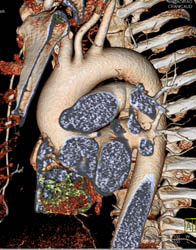 Dilated Ascending Aorta and Normal Branch Vessels Off the Arch - CTisus CT Scan