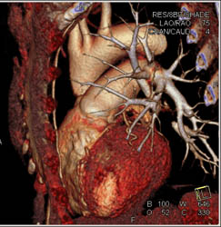 Aortic Repair and Dilated Ascending Aorta With Reimplanted Coronary Arteries - CTisus CT Scan