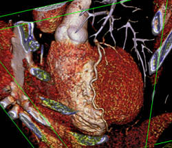 Plaque LAD With Stenosis in the 50% Range - CTisus CT Scan