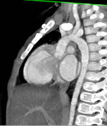 Stenosis in Aortic Arch and Origin of Great Vessels - CTisus CT Scan